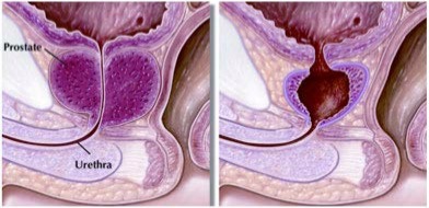 Holmium Laser Enucleation Prostatectomy