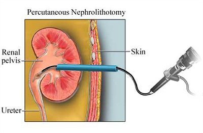 Percutaneous Nephrolithotomy (PCNL) Including Mini-PERC (mini PCNL)