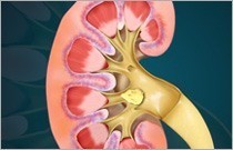 Kidney Stones