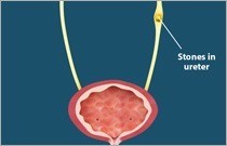 Ureteric Stones