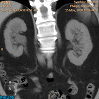 Minimally Invasive Stone Surgery - Before