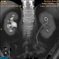 Minimally Invasive Stone Surgery - After